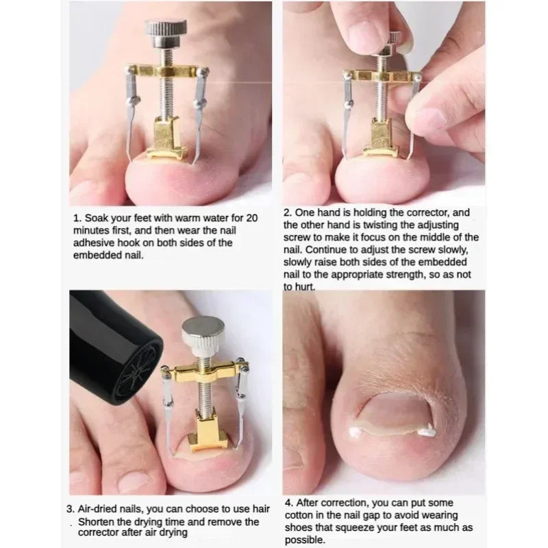 Precision Ingrown Toenail Straightening Clip - Effective Home Solution