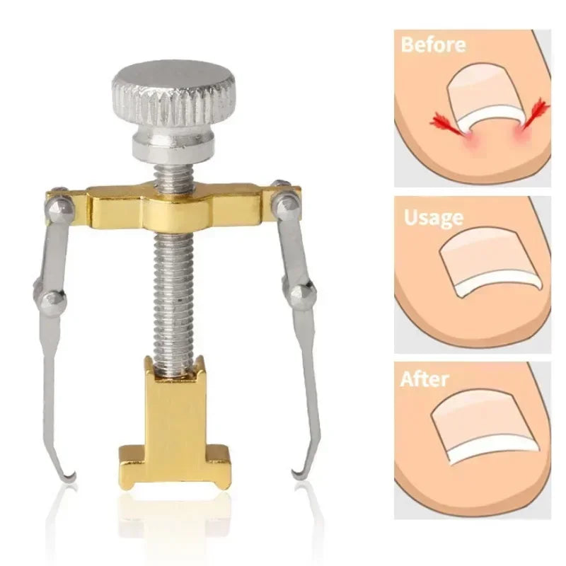 Precision Ingrown Toenail Straightening Clip - Effective Home Solution