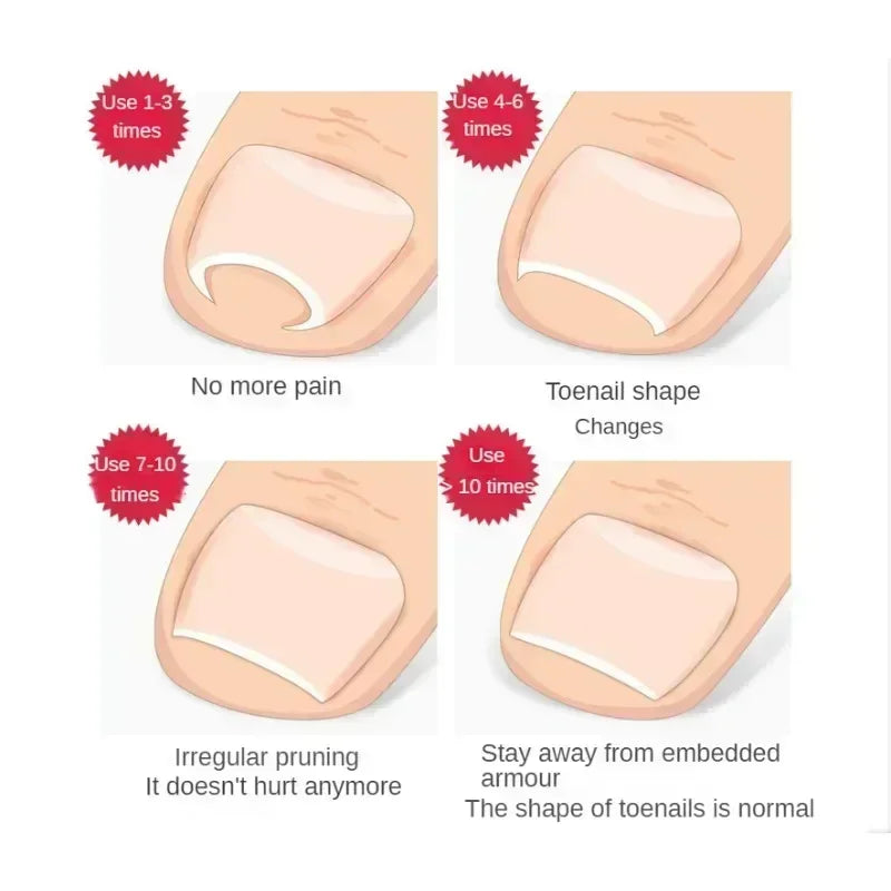 Precision Ingrown Toenail Straightening Clip - Effective Home Solution